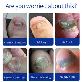 Dr.Kondo Nail Fungal Treatment Toe Nail Fungus Removal